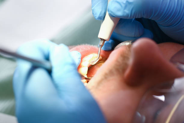 Best Urgent Care for Lost Fillings or Crowns in August, CA